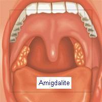 20051128222131-amigdalite.jpg